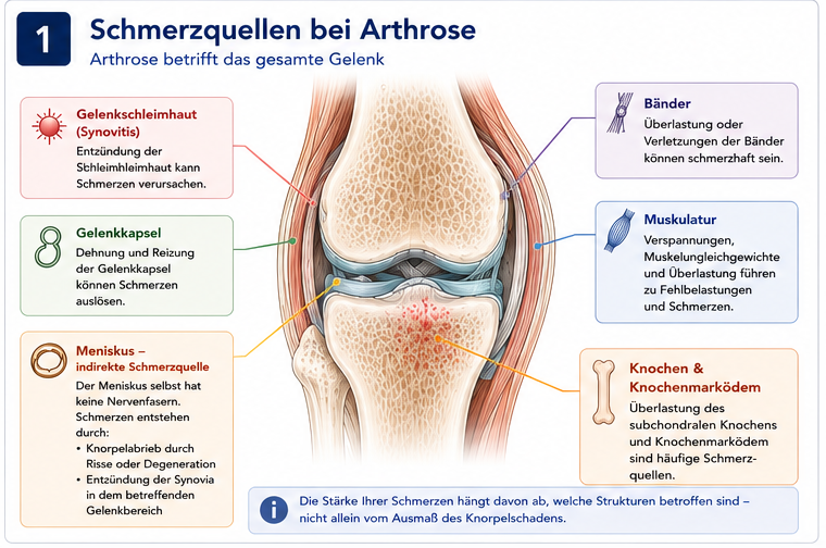 Infografik zu den möglichen Schmerzquellen bei Arthrose: Gelenkschleimhaut, Gelenkkapsel, Meniskus als indirekte Schmerzquelle, Muskulatur, Bänder und subchondraler Knochen.