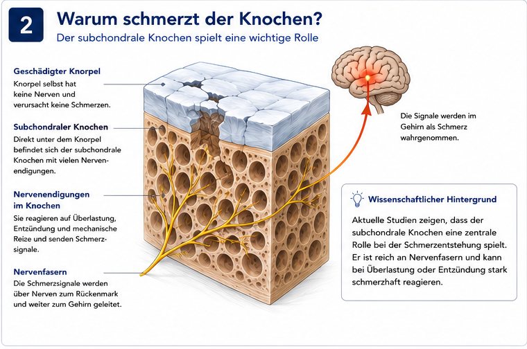 Infografik zum subchondralen Knochen mit Nervenfasern und Weiterleitung von Schmerzsignalen zum Gehirn.